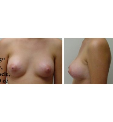 Axillary Breast Augmentation After